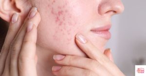Woman's face with acne on the cheek. This article discusses hormonal imbalance symptoms.